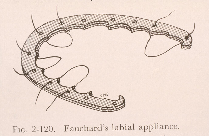 Pierre Fauchard's bandalette