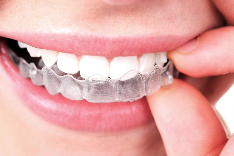 Invisalign: rechte tanden door een doorzichtig hoesje